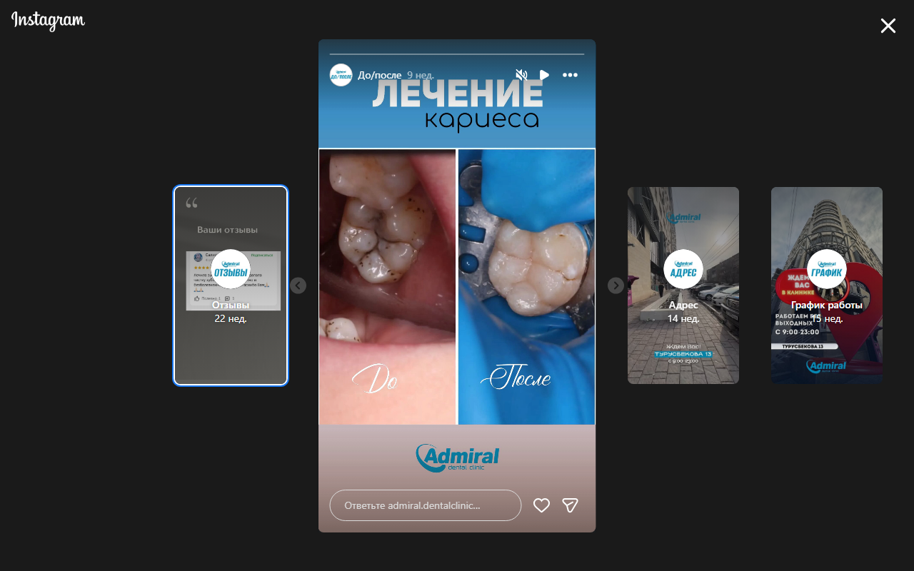 Виниры до и после