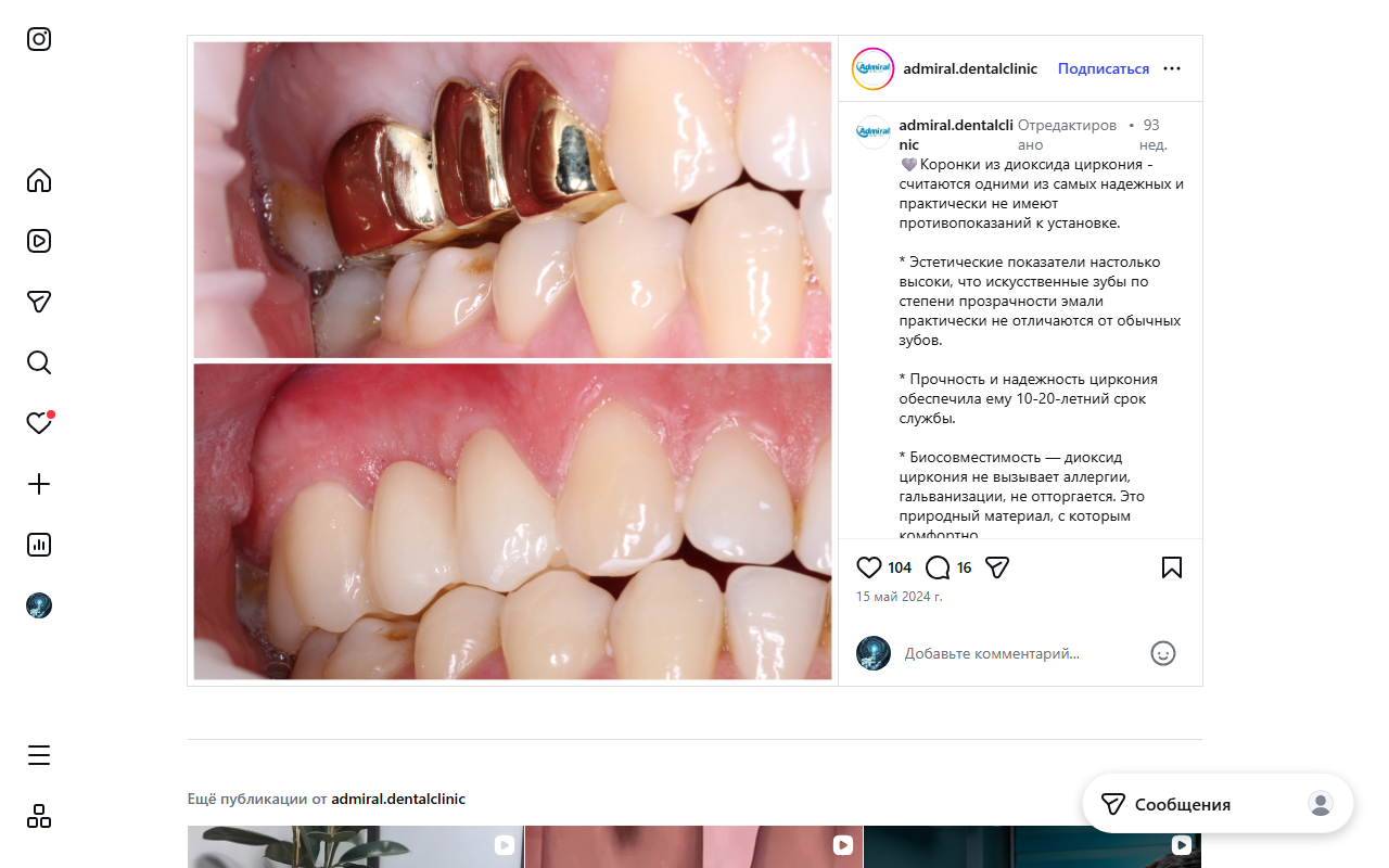 Протезирование зубов цирконий