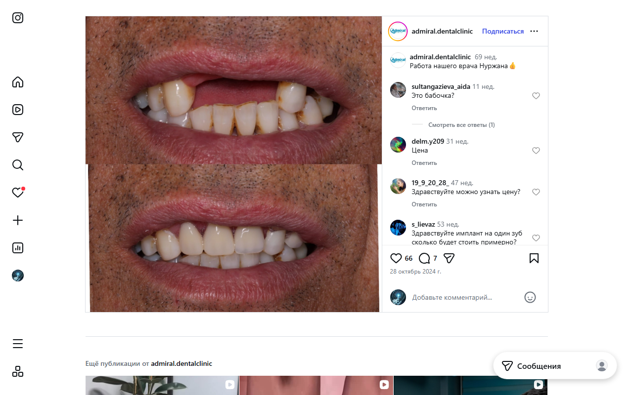 Лечение кариеса до после